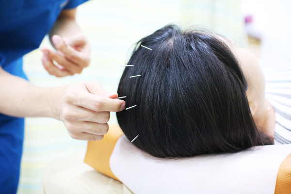 두피 침치료 (사진제공=대전대학교 대전한방병원)